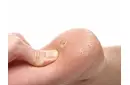 Ayak Topuk Dikeni Belirtileri ve Tedavisi